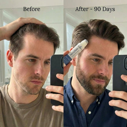 Newplum: Advanced Hair Growth Roll-On Serum